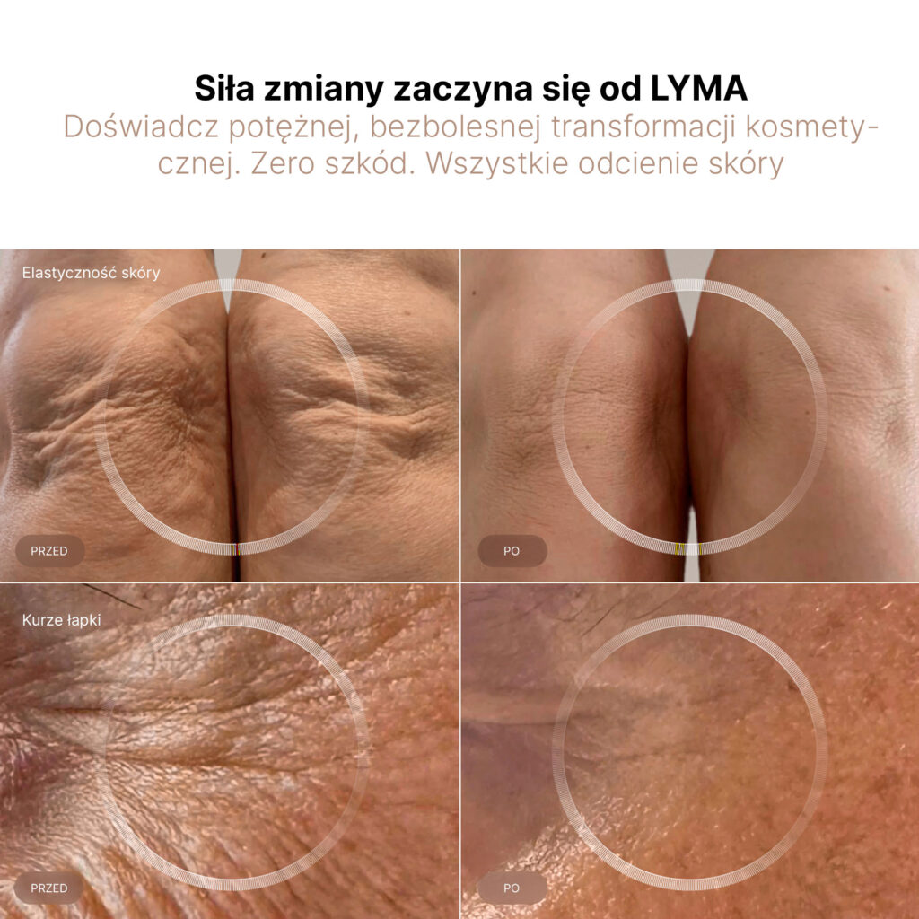 Zmiany skóry przed i po zabiegu LYMA.